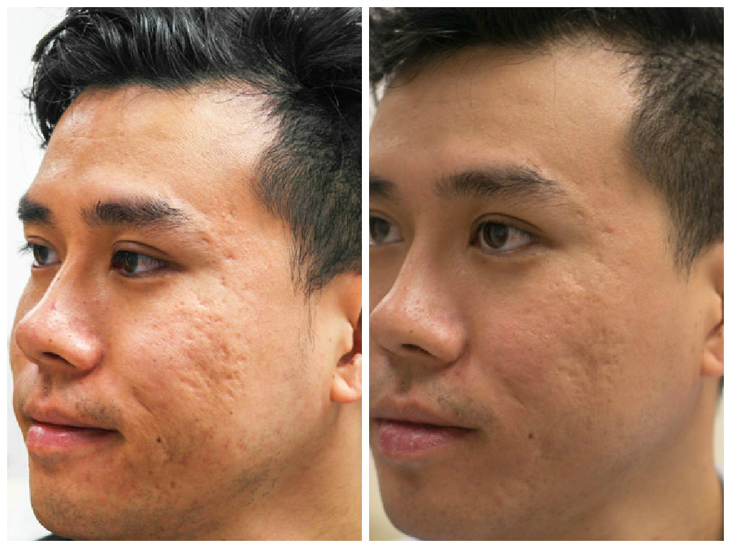 Acne Scar Treatment Co2 Laser Infini Results After A Couple Sessions