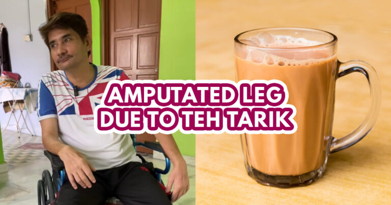 Leg amputated from too much Teh Tarik