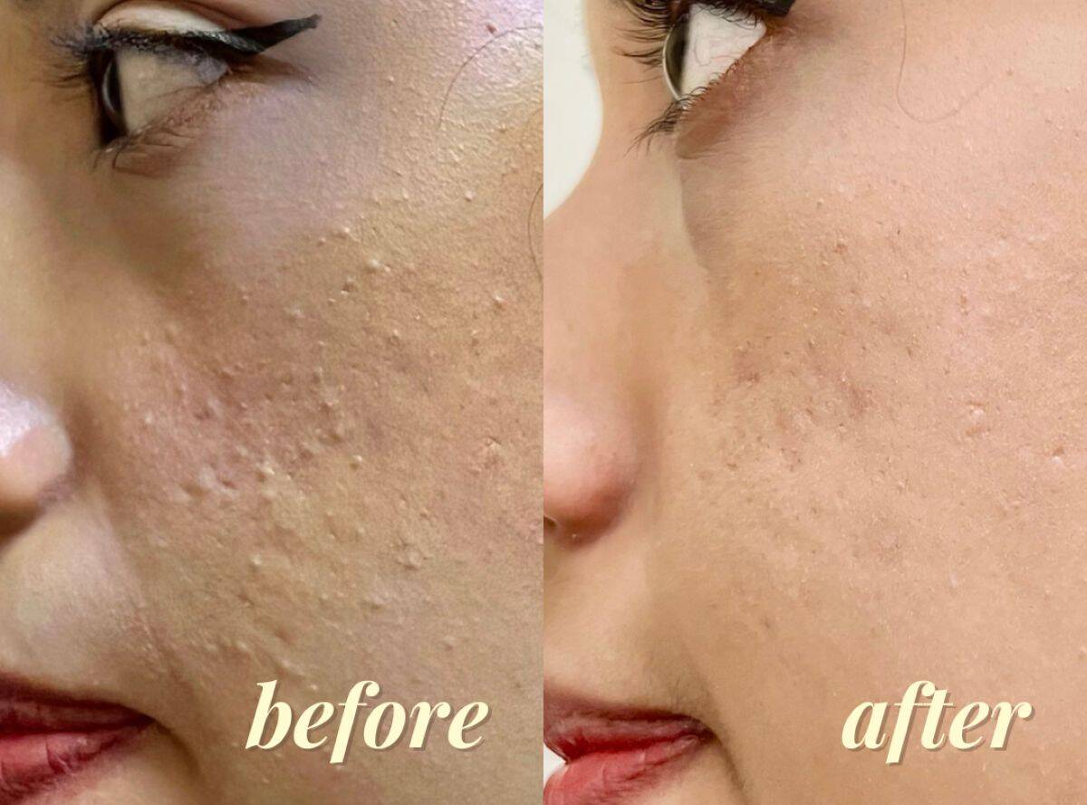 Best Facial in Singapore - Before and After