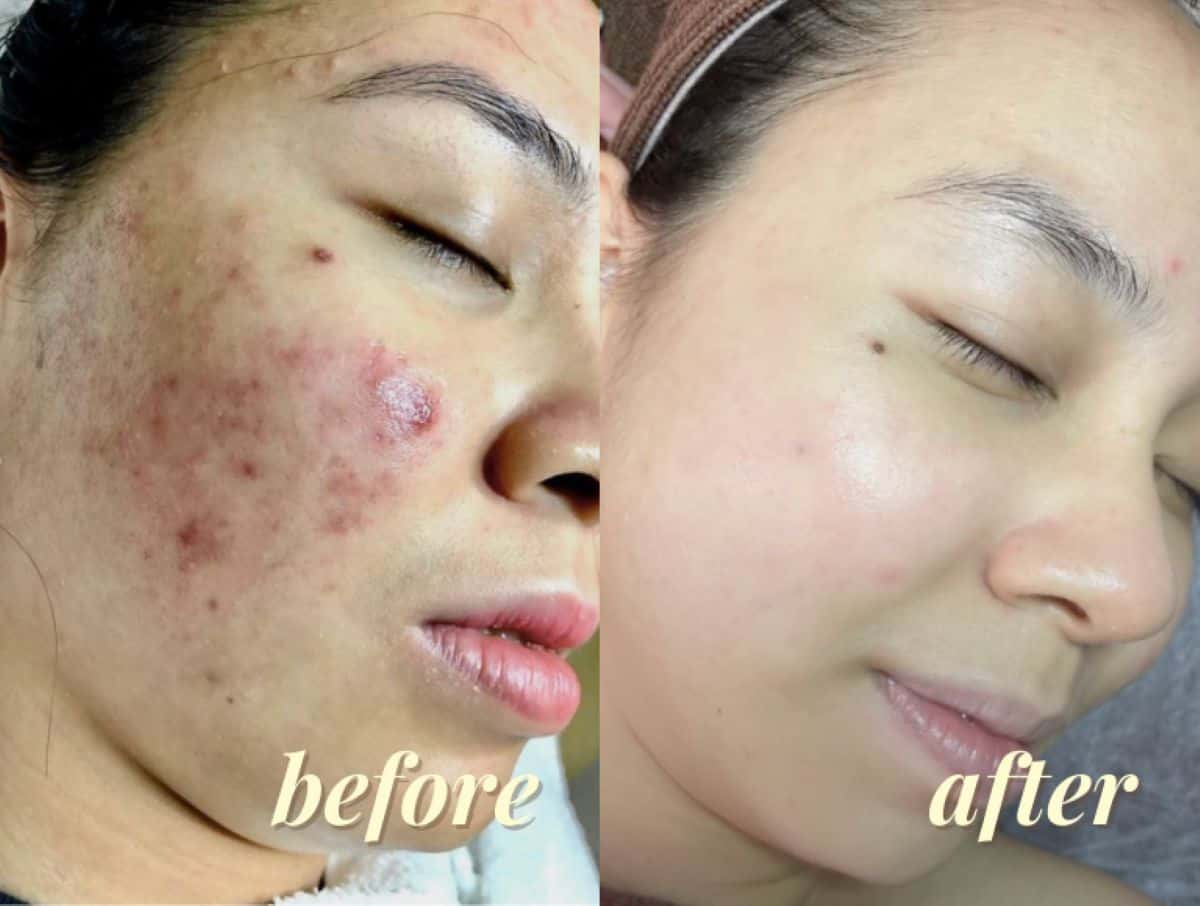 Best Facial in Singapore - Before and After