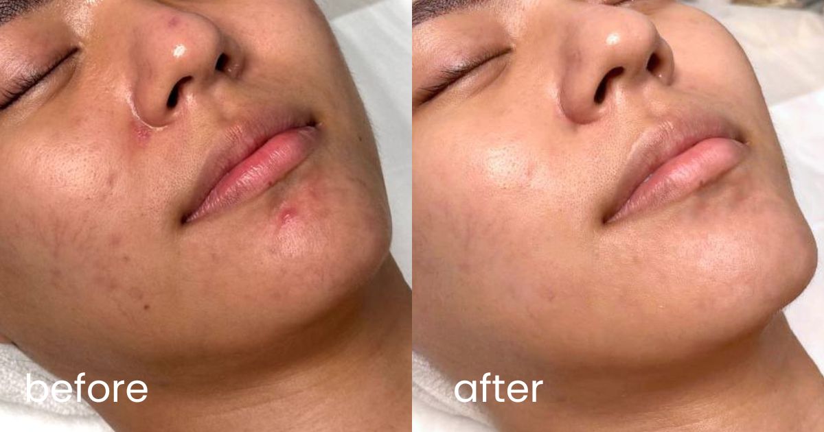 Best facials - AsterSpring Luminfusion Therapy